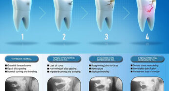 Chiropractic Care & Tooth Decay