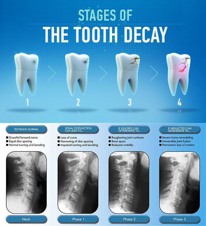 Chiropractic Care & Tooth Decay